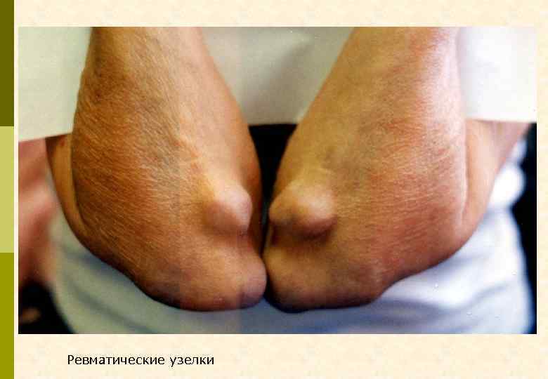 Ревматические узелки 