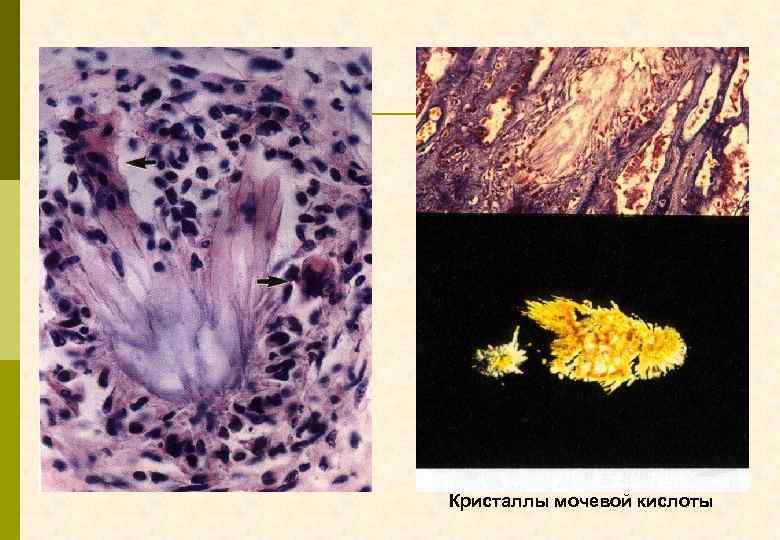 Кристаллы мочевой кислоты 