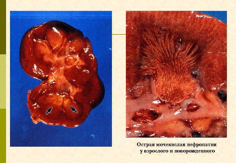 Острая мочекислая нефропатия у взрослого и новорожденного 