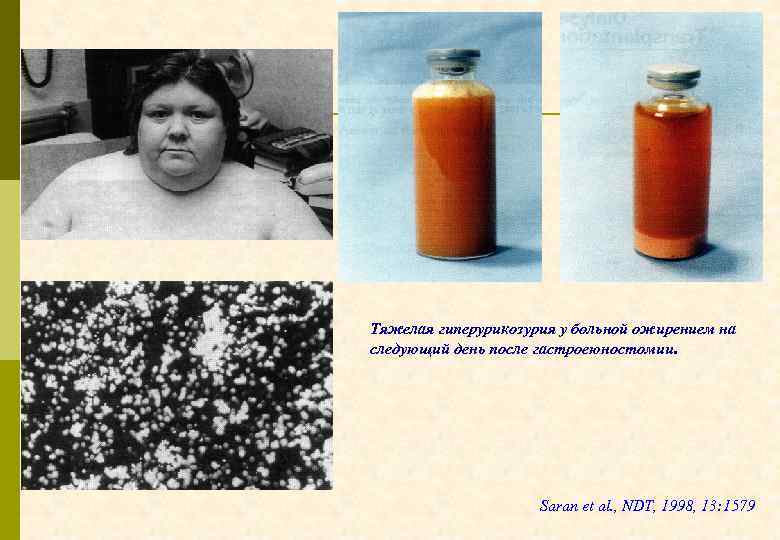 Тяжелая гиперурикозурия у больной ожирением на следующий день после гастроеюностомии. Saran et al. ,