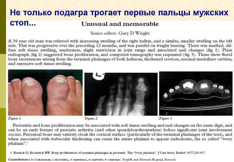 Не только подагра трогает первые пальцы мужских стоп. . . 