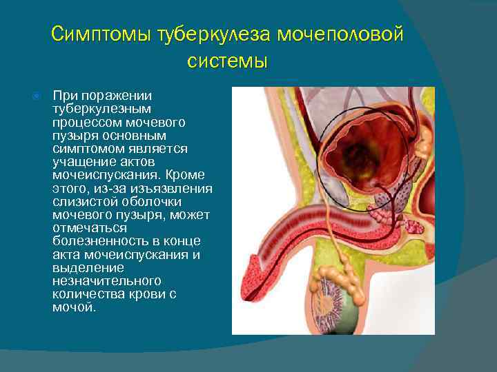 Симптомы туберкулеза мочеполовой системы При поражении туберкулезным процессом мочевого пузыря основным симптомом является учащение