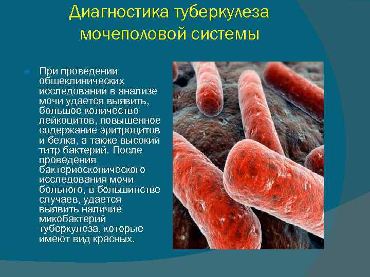 Диагностика туберкулеза мочеполовой системы При проведении общеклинических исследований в анализе мочи удается выявить, большое