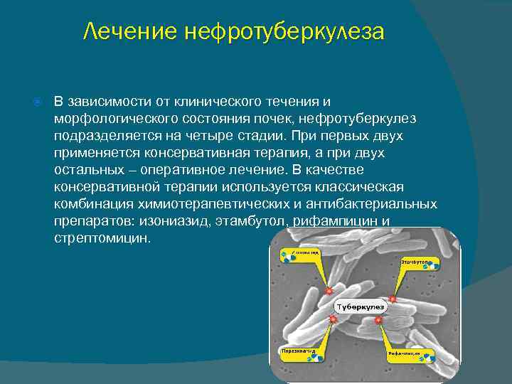 Презентация туберкулез мочевыделительной системы