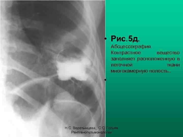  • Рис. 5 д. Абсцессография. Контрастное вещество заполняет расположенную в легочной ткани многокамерную