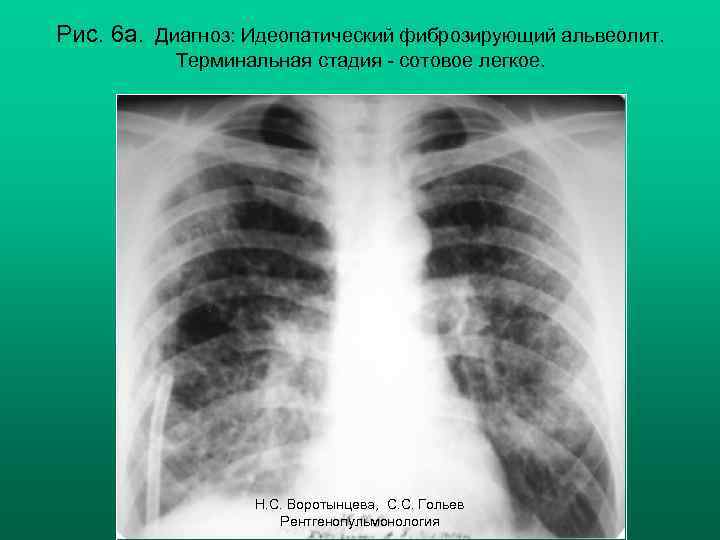 Рис. 6 а. Диагноз: Идеопатический фиброзирующий альвеолит. Терминальная стадия - сотовое легкое. Н. С.