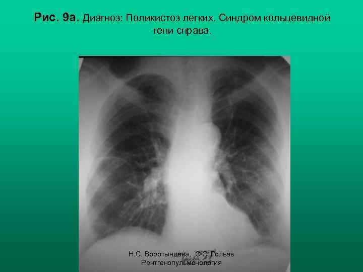 Рис. 9 а. Диагноз: Поликистоз легких. Синдром кольцевидной тени справа. Н. С. Воротынцева, С.