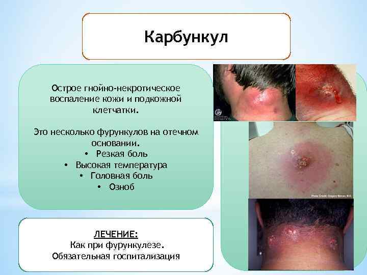 Карбункул Острое гнойно-некротическое воспаление кожи и подкожной клетчатки. Это несколько фурункулов на отечном основании.