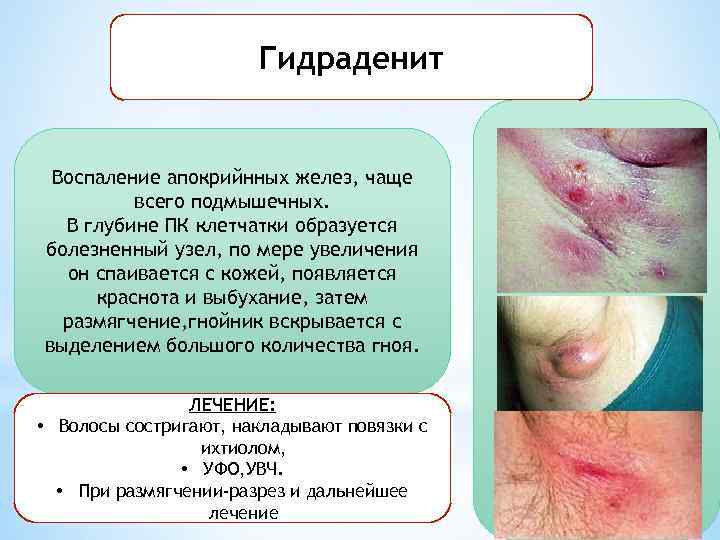 Гидраденит Воспаление апокрийнных желез, чаще всего подмышечных. В глубине ПК клетчатки образуется болезненный узел,