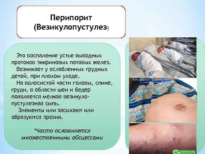 Перипорит (Везикулопустулез) Это воспаление устье выводных протоков эккриновых потовых желез. Возникает у ослабленных грудных
