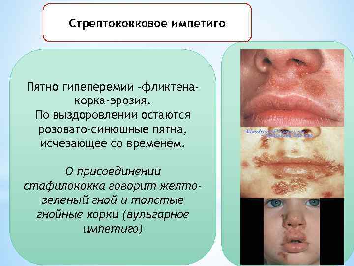 Стрептококковое импетиго Пятно гипеперемии –фликтенакорка-эрозия. По выздоровлении остаются розовато-синюшные пятна, исчезающее со временем. О