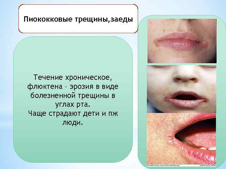 Пиококковые трещины, заеды Течение хроническое, флюктена – эрозия в виде болезненной трещины в углах