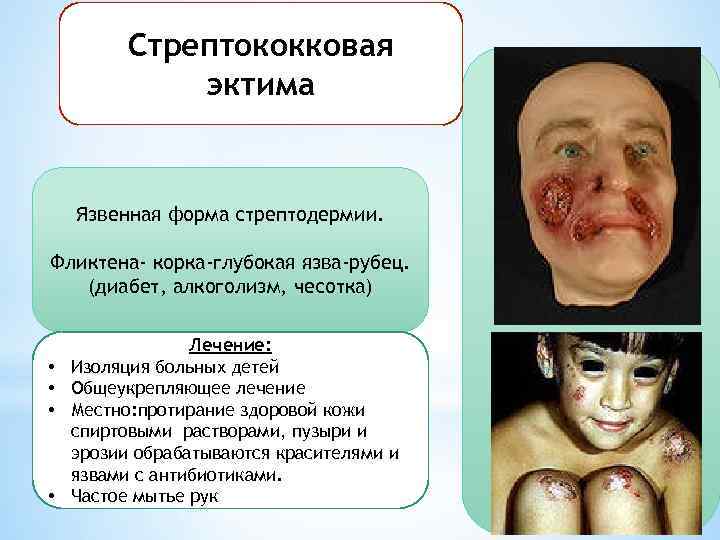 Стрептококковая эктима Язвенная форма стрептодермии. Фликтена- корка-глубокая язва-рубец. (диабет, алкоголизм, чесотка) • • Лечение:
