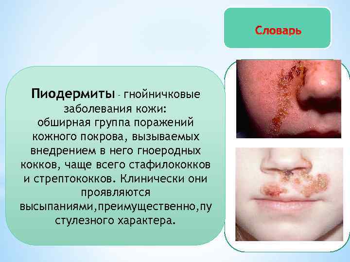 Пиодермиты – гнойничковые заболевания кожи: обширная группа поражений кожного покрова, вызываемых внедрением в него