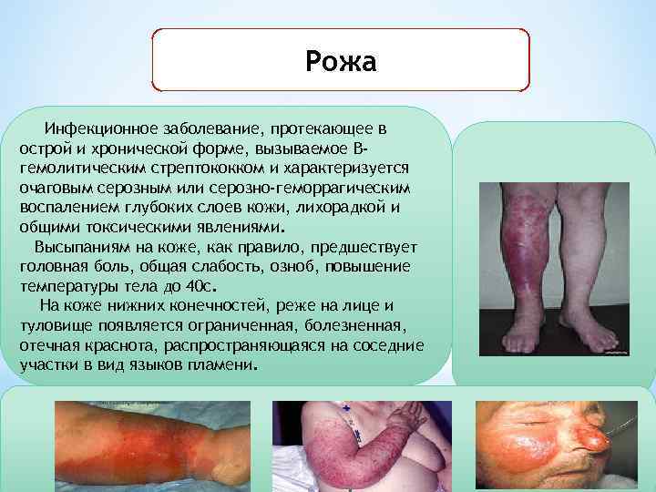 Рожа Инфекционное заболевание, протекающее в острой и хронической форме, вызываемое Вгемолитическим стрептококком и характеризуется