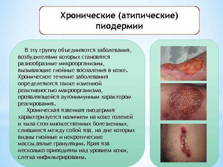 Хронические (атипические) пиодермии В эту группу объединяются заболевания, возбудителями которых становятся разнообразные микроорганизмы, вызывающие