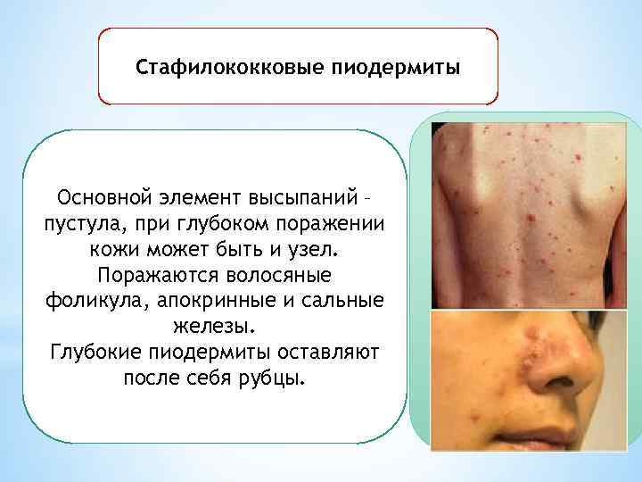 Стафилококковые пиодермиты Основной элемент высыпаний – пустула, при глубоком поражении кожи может быть и