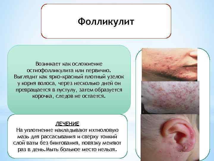 Фолликулит Возникает как осложнение остиофолликулита или первично. Выглядит как ярко-красный плотный узелок у корня