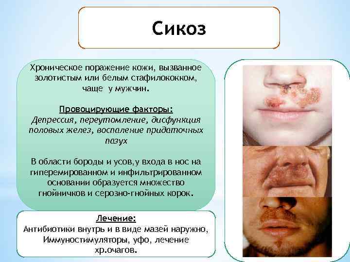 Сикоз Хроническое поражение кожи, вызванное золотистым или белым стафилококком, чаще у мужчин. Провоцирующие факторы:
