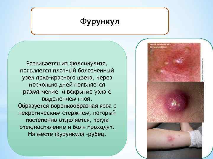 Фурункул Развивается из фолликулита, появляется плотный болезненный узел ярко-красного цвета, через несколько дней появляется