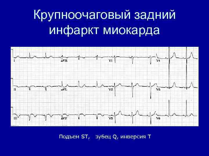Признаки трансмурального инфаркта. Крупноочаговый инфаркт миокарда на ЭКГ. Мелкоочаговый крупноочаговый трансмуральный инфаркт миокарда. Задний инфаркт миокарда. Задний q инфаркт миокарда.