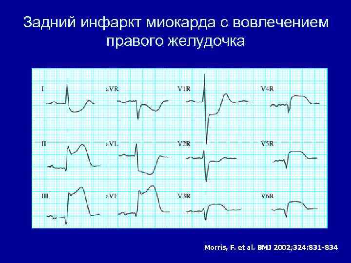 Диагноз инфаркт миокарда. Инфаркт миокарда правого желудочка на ЭКГ. Правожелудочковый инфаркт миокарда ЭКГ. Инфаркт правого желудочка на ЭКГ. ЭКГ критерии инфаркта миокарда правого желудочка.