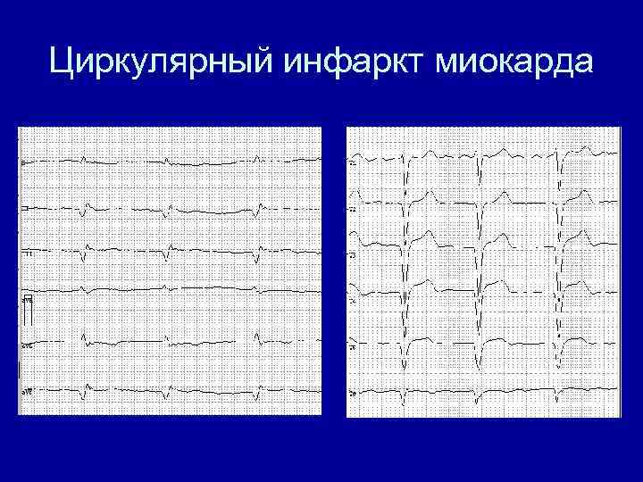 Инфаркт миокарда трансмуральный перегородочный