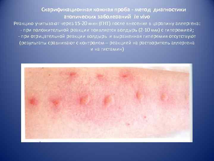Скарификационная кожная проба - метод диагностики атопических заболеваний in vivo Реакцию учитывают через 15