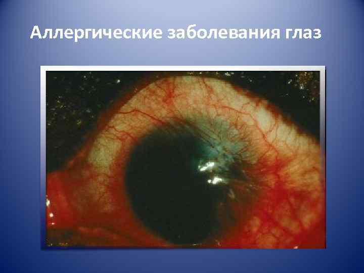 Аллергические заболевания глаз 