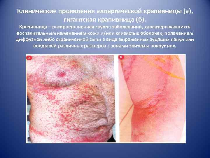 Клинические проявления аллергической крапивницы (а), гигантская крапивница (б). Крапивница – распространенная группа заболеваний, характеризующихся