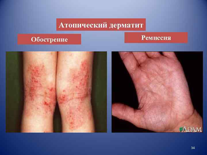 Атопический дерматит Обострение Ремиссия 34 
