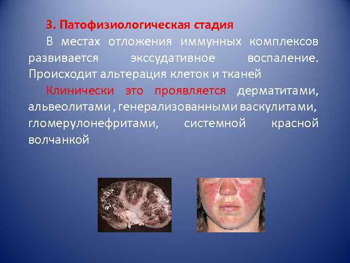 3. Патофизиологическая стадия В местах отложения иммунных комплексов развивается экссудативное воспаление. Происходит альтерация клеток