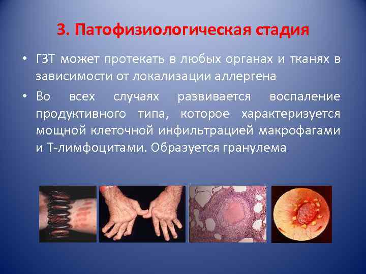 3. Патофизиологическая стадия • ГЗТ может протекать в любых органах и тканях в зависимости