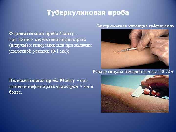 Туберкулиновая проба Внутрикожная инъекция туберкулина Отрицательная проба Манту – при полном отсутствии инфильтрата (папулы)