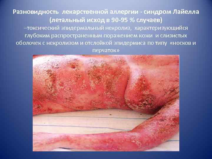 Разновидность лекарственной аллергии - синдром Лайелла (летальный исход в 90 -95 % случаев) –токсический
