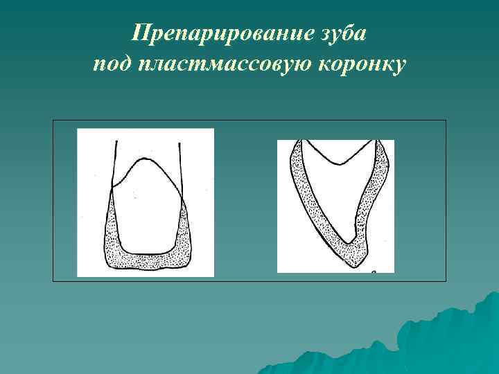 Схема сошлифовывания гипса на модели при изготовлении иммедиат протеза