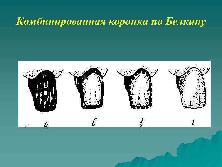 Штампованные коронки этапы