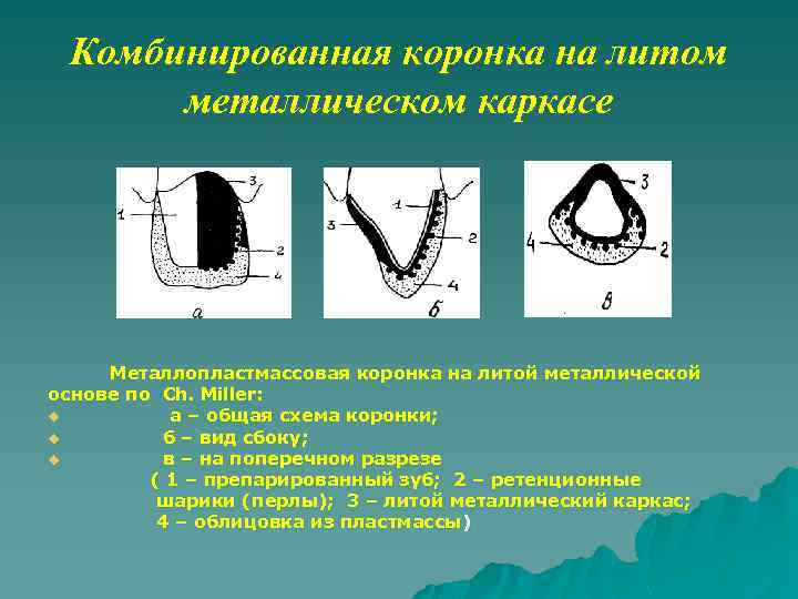 Комбинированная коронка на литом металлическом каркасе Металлопластмассовая коронка на литой металлической основе по Ch.