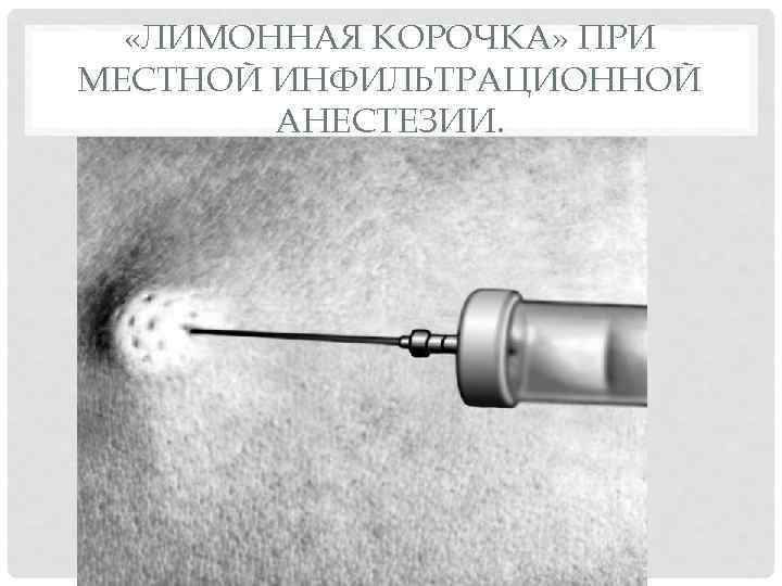  «ЛИМОННАЯ КОРОЧКА» ПРИ МЕСТНОЙ ИНФИЛЬТРАЦИОННОЙ АНЕСТЕЗИИ. 