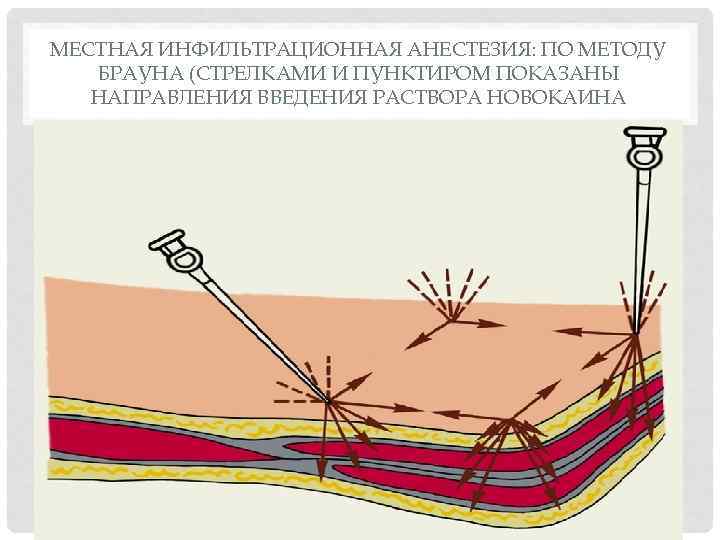 МЕСТНАЯ ИНФИЛЬТРАЦИОННАЯ АНЕСТЕЗИЯ: ПО МЕТОДУ БРАУНА (СТРЕЛКАМИ И ПУНКТИРОМ ПОКАЗАНЫ НАПРАВЛЕНИЯ ВВЕДЕНИЯ РАСТВОРА НОВОКАИНА