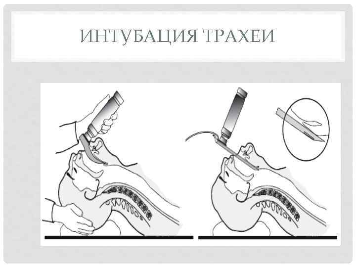 ИНТУБАЦИЯ ТРАХЕИ 