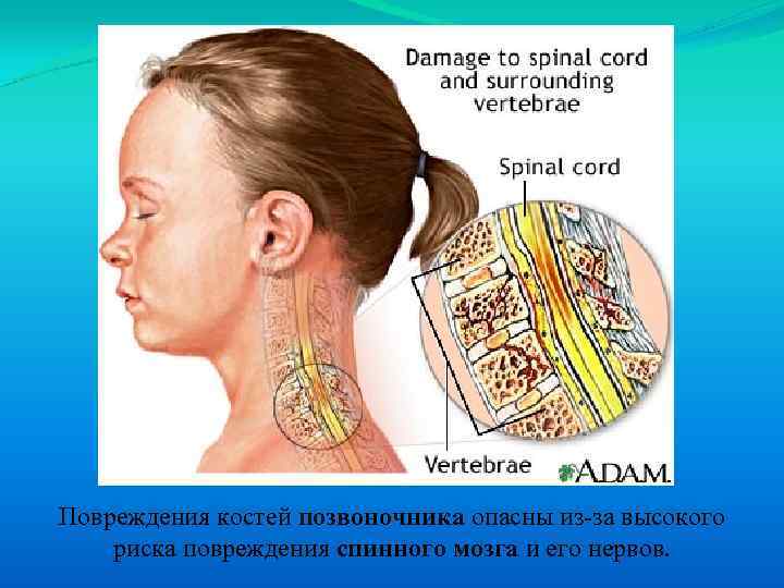 Повреждения костей позвоночника опасны из-за высокого риска повреждения спинного мозга и его нервов. 