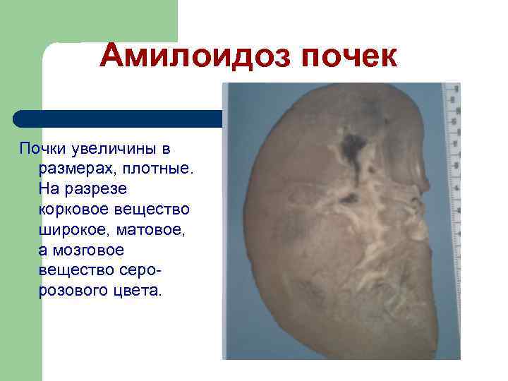 Амилоидоз почек Почки увеличины в размерах, плотные. На разрезе корковое вещество широкое, матовое, а