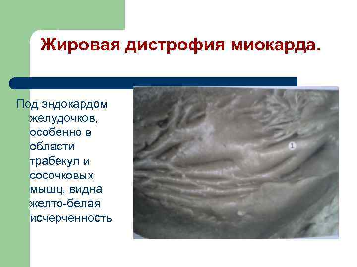 Жировая дистрофия миокарда. Под эндокардом желудочков, особенно в области трабекул и сосочковых мышц, видна