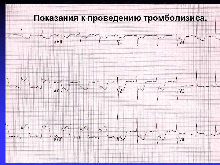 Показания к проведению тромболизиса. 