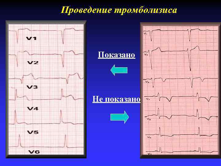 Проведение тромболизиса Показано Не показано 