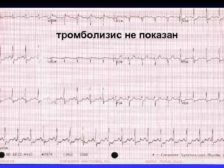 тромболизис не показан 