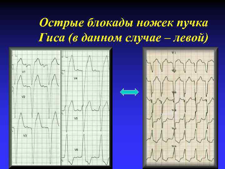 Острые блокады ножек пучка Гиса (в данном случае – левой) 