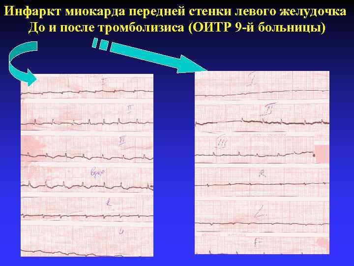 Инфаркт миокарда передней стенки левого желудочка До и после тромболизиса (ОИТР 9 -й больницы)