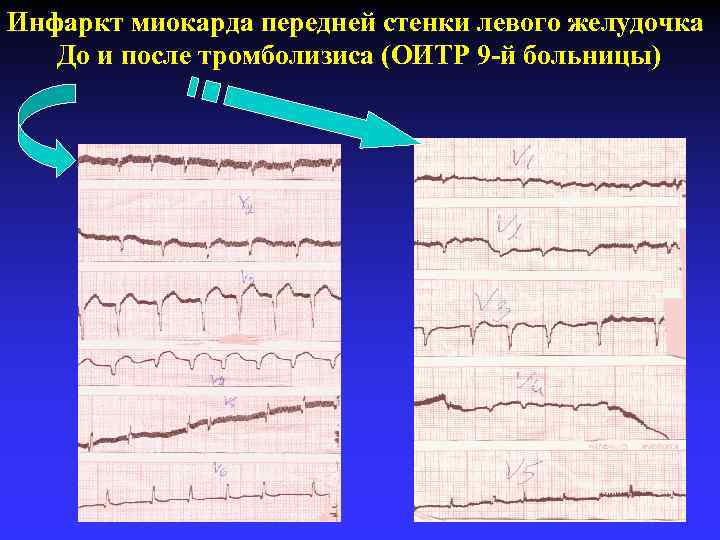 Инфаркт миокарда передней стенки левого желудочка До и после тромболизиса (ОИТР 9 -й больницы)